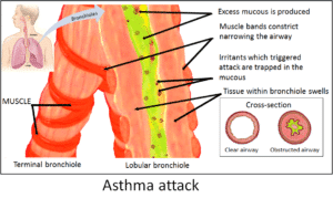 अस्थमा क्या हैं जानिए हिंदी में (What is Asthma in Hindi)